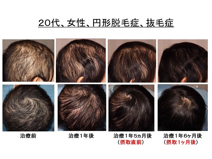 症 抜毛